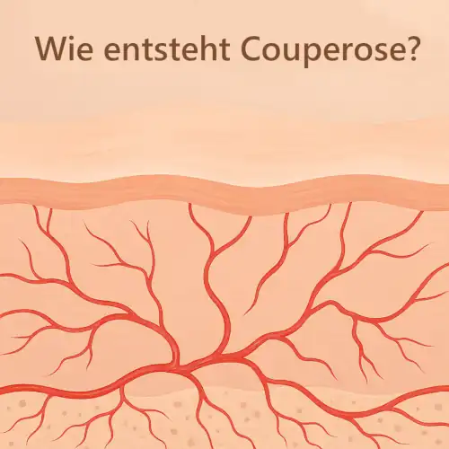 Couperose entstehung